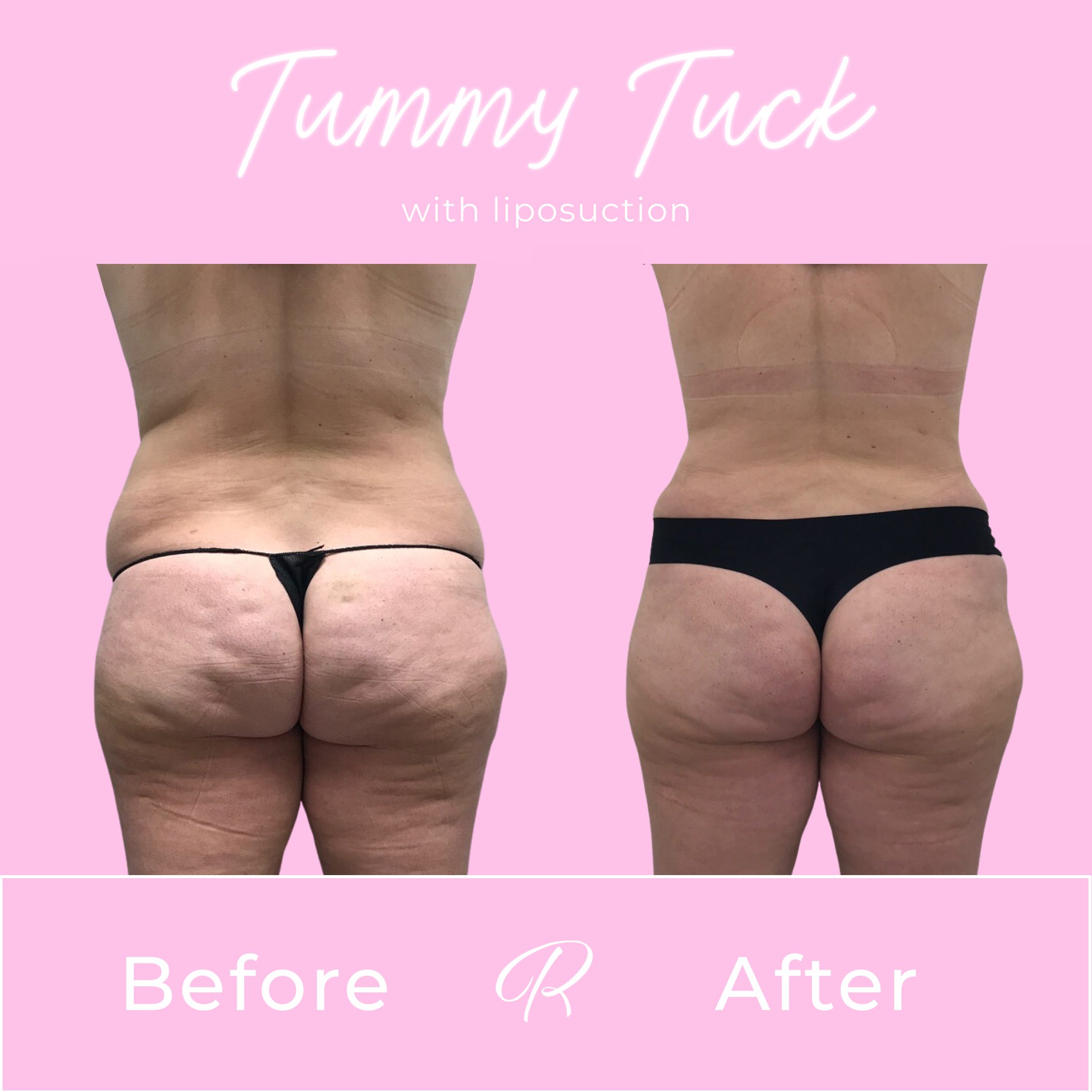 Tummy Tuck Before & After Gallery - Patient 13260 - Image 3