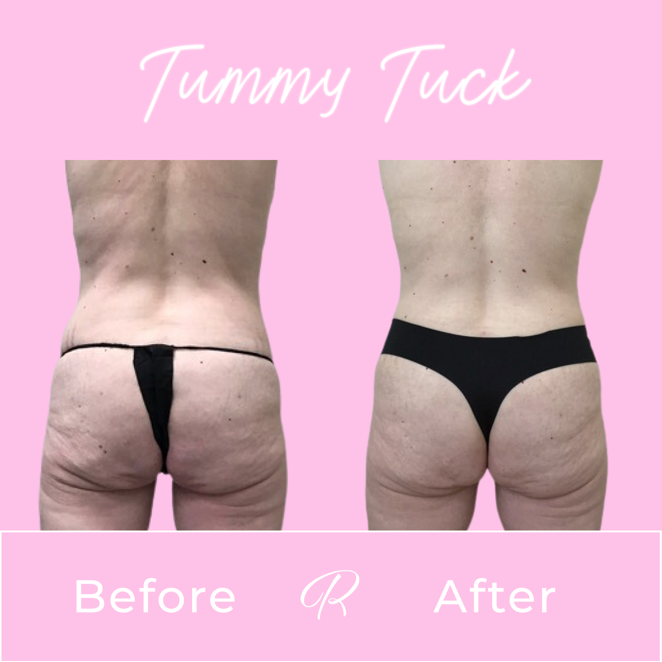 Tummy Tuck Before & After Gallery - Patient 13259 - Image 3