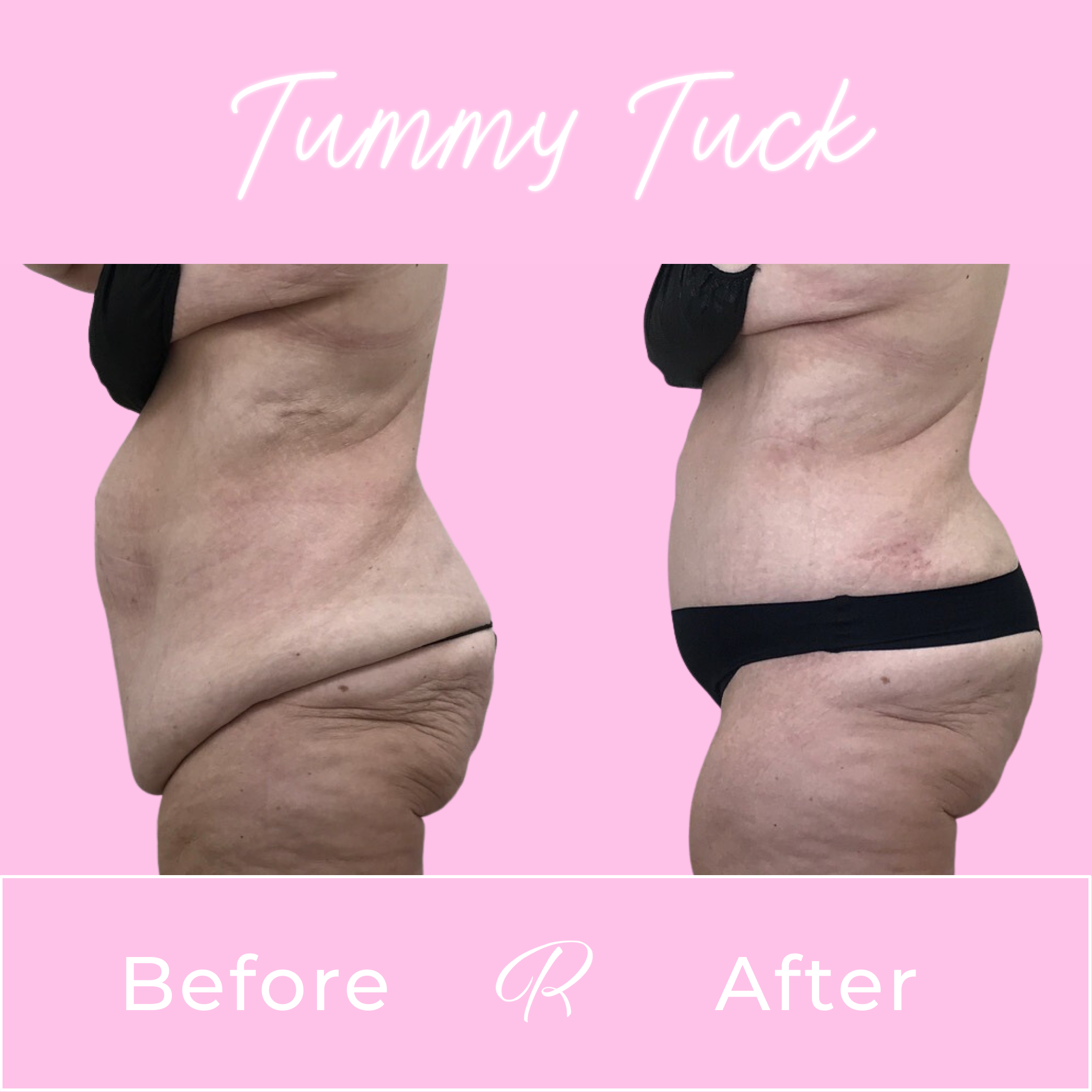 Tummy Tuck Before & After Gallery - Patient 13265 - Image 2
