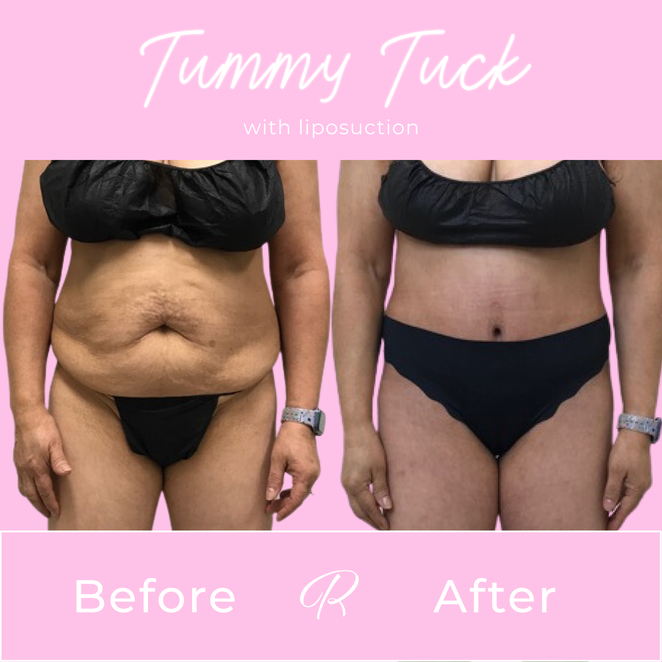 Tummy Tuck Before & After Gallery - Patient 13269 - Image 1