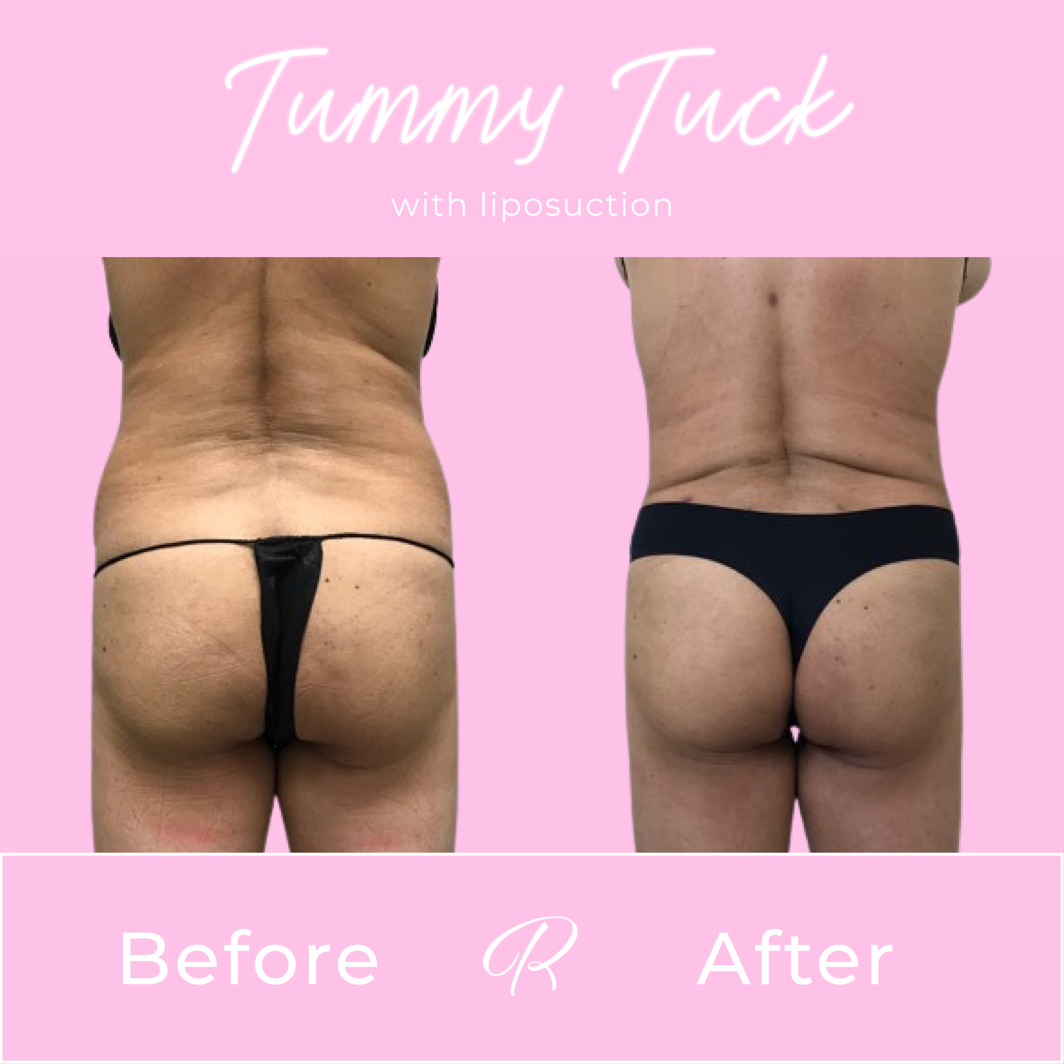 Tummy Tuck Before & After Gallery - Patient 13269 - Image 3