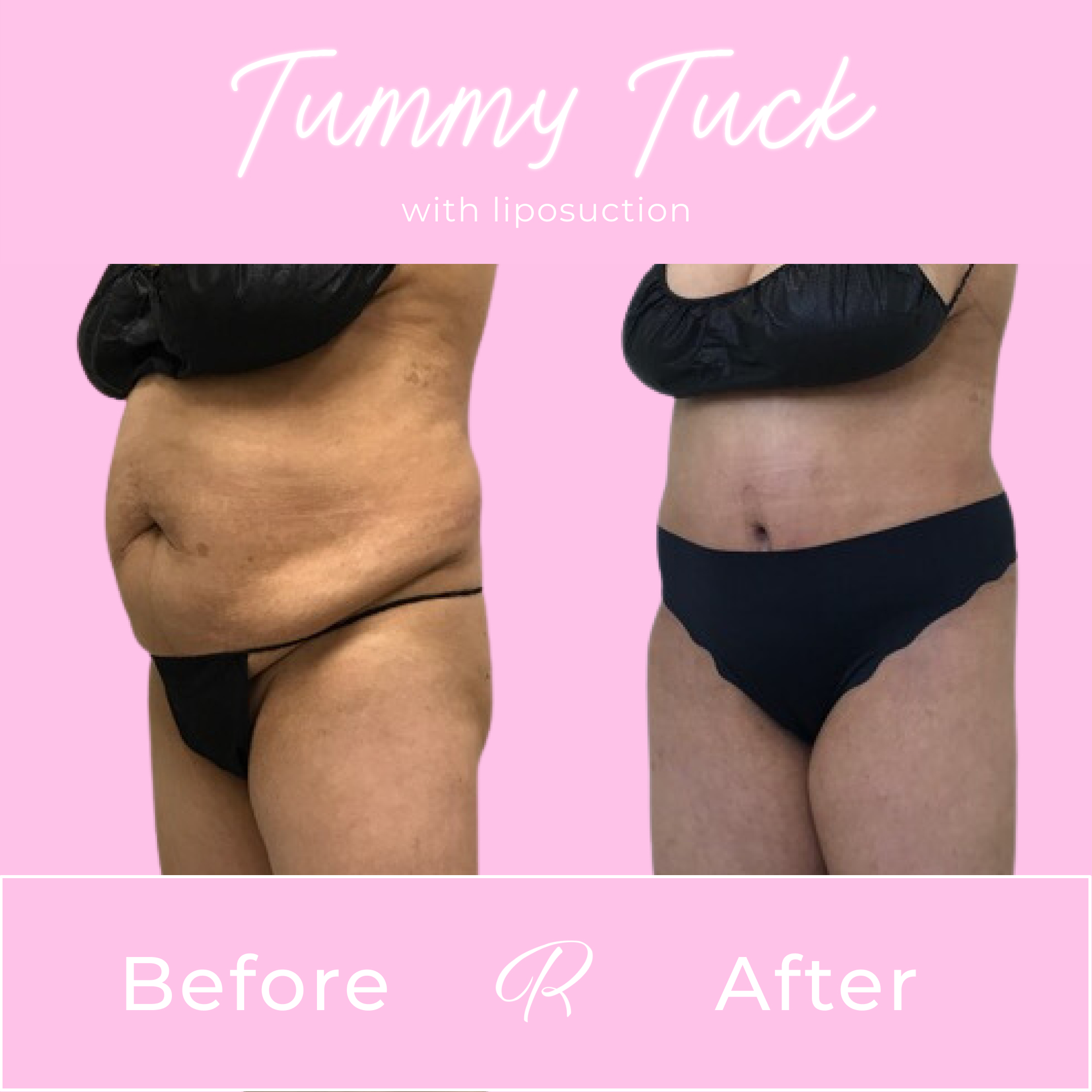 Tummy Tuck Before & After Gallery - Patient 13269 - Image 4