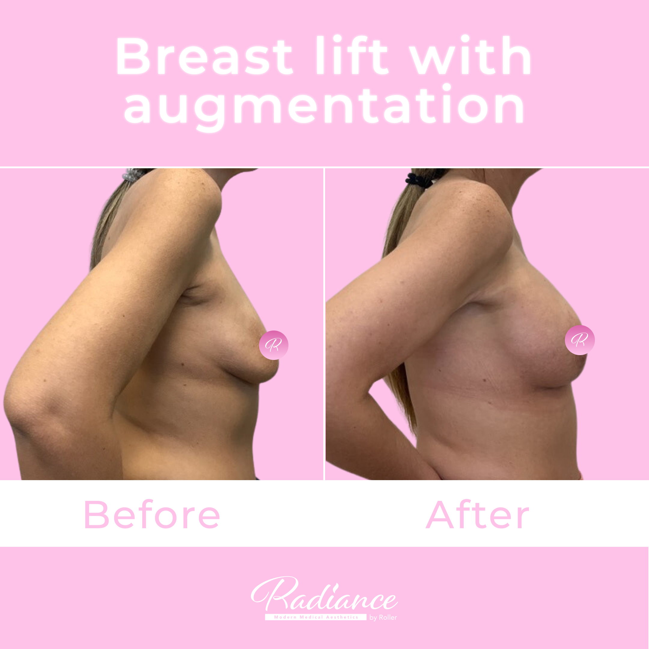 Breast Lift With Augmentation Before & After Gallery - Patient 13424 - Image 5