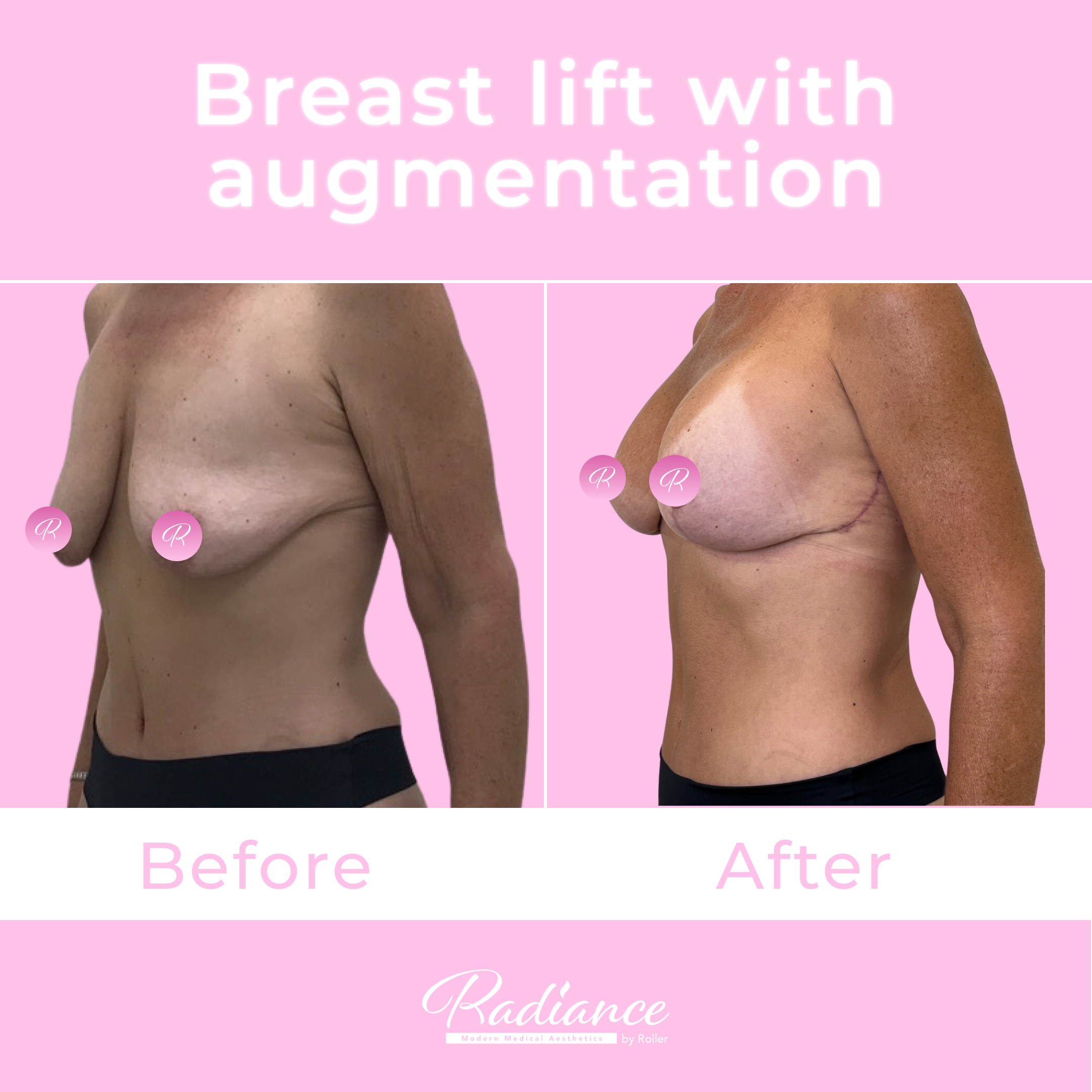 Breast Lift With Augmentation Before & After Gallery - Patient 13425 - Image 2