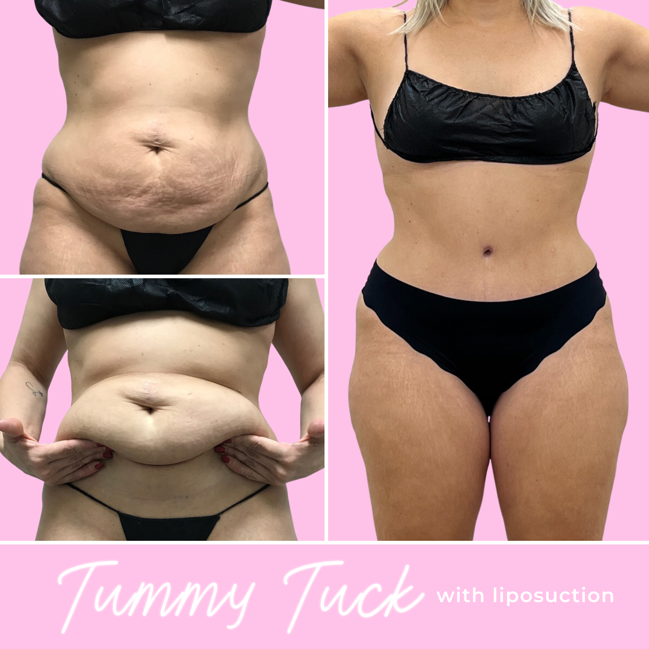 Tummy Tuck Before & After Gallery - Patient 13281 - Image 1