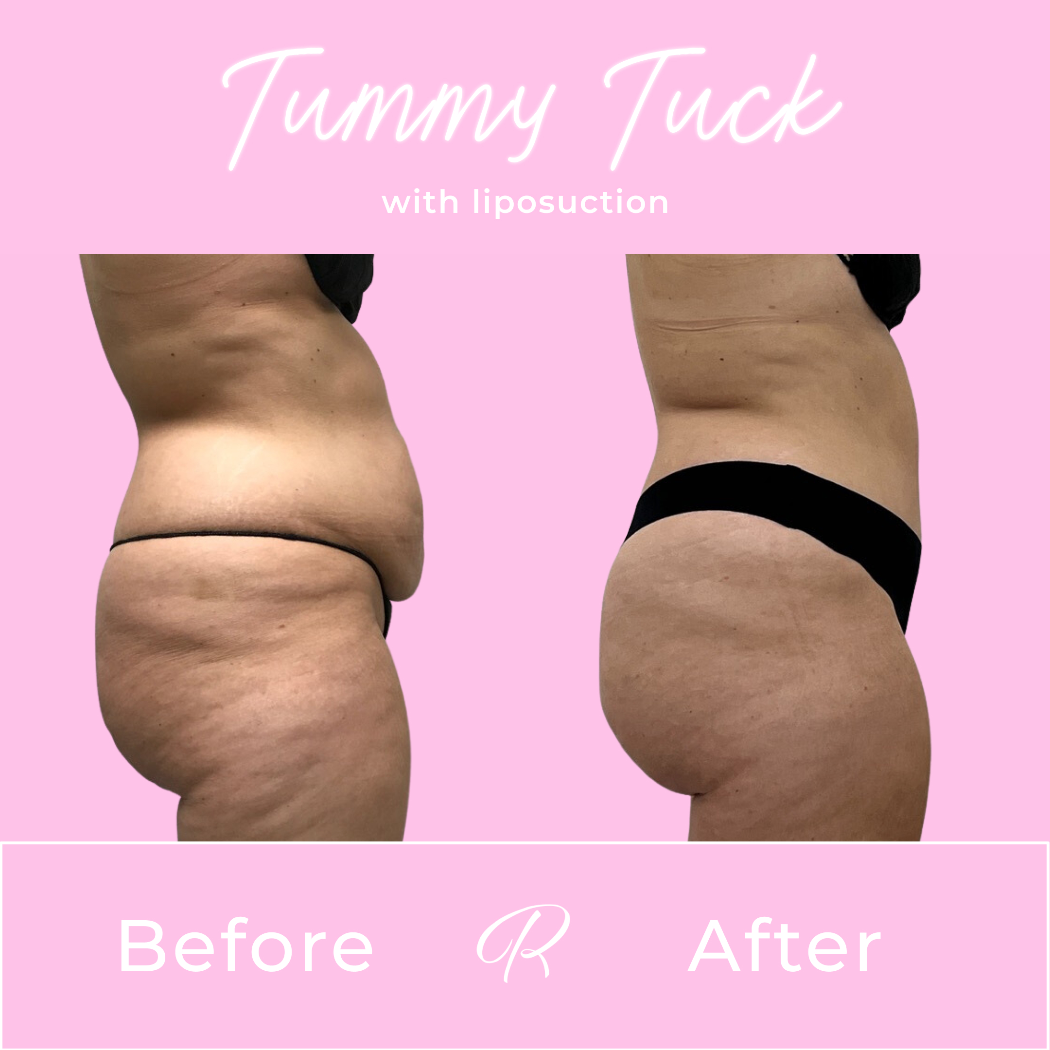 Tummy Tuck Before & After Gallery - Patient 13281 - Image 5