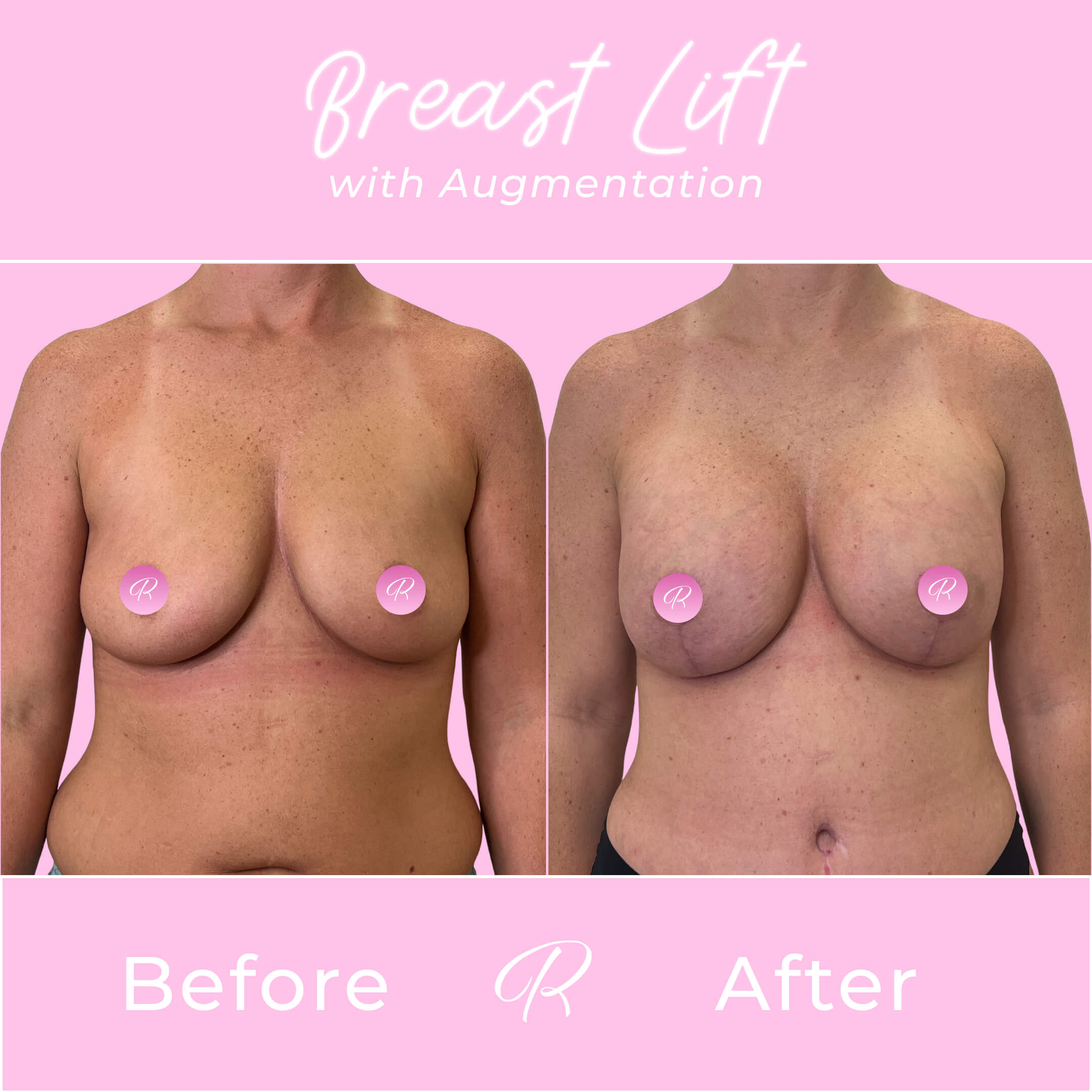 Breast Lift With Augmentation Before & After Gallery - Patient 13426 - Image 1