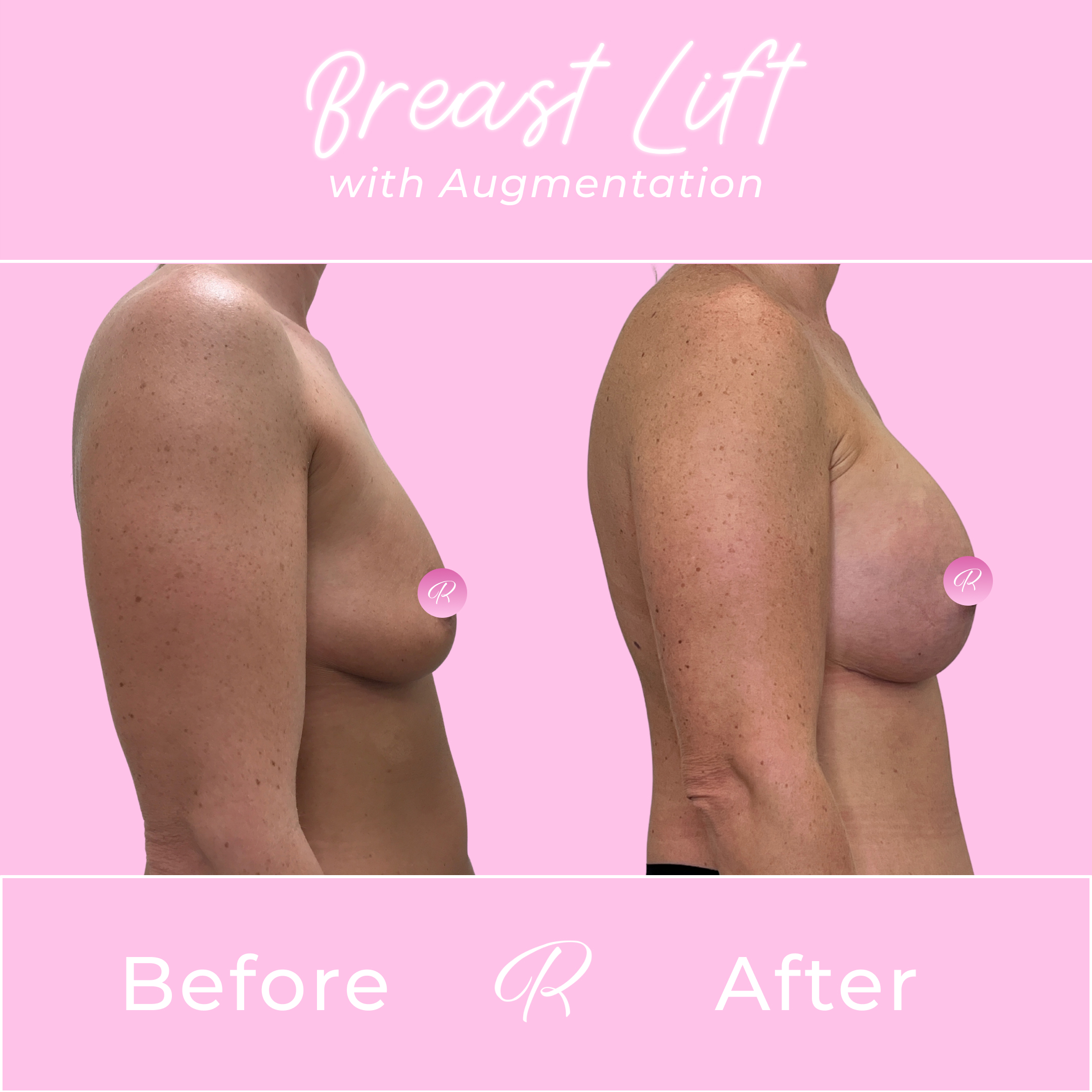 Breast Lift With Augmentation Before & After Gallery - Patient 13426 - Image 3