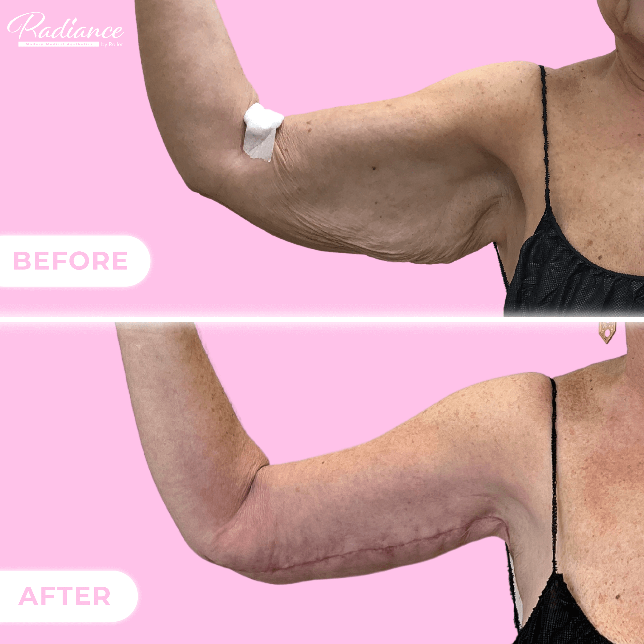 Arm Lift Before & After Gallery - Patient 13436 - Image 1