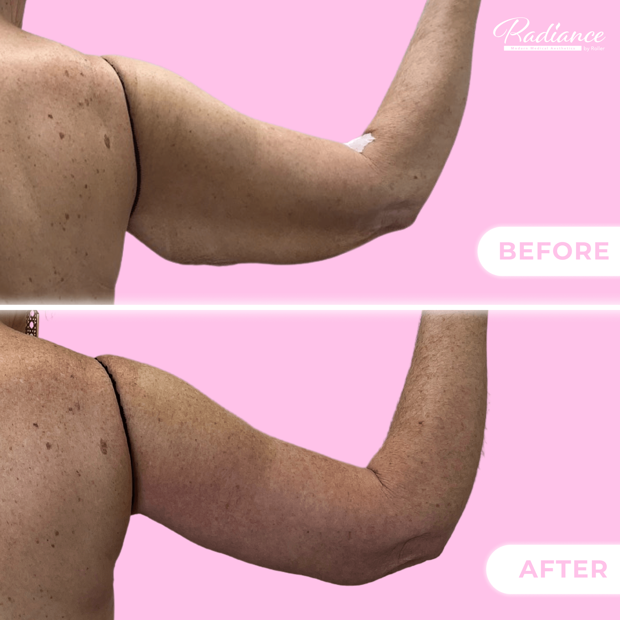 Arm Lift Before & After Gallery - Patient 13436 - Image 2
