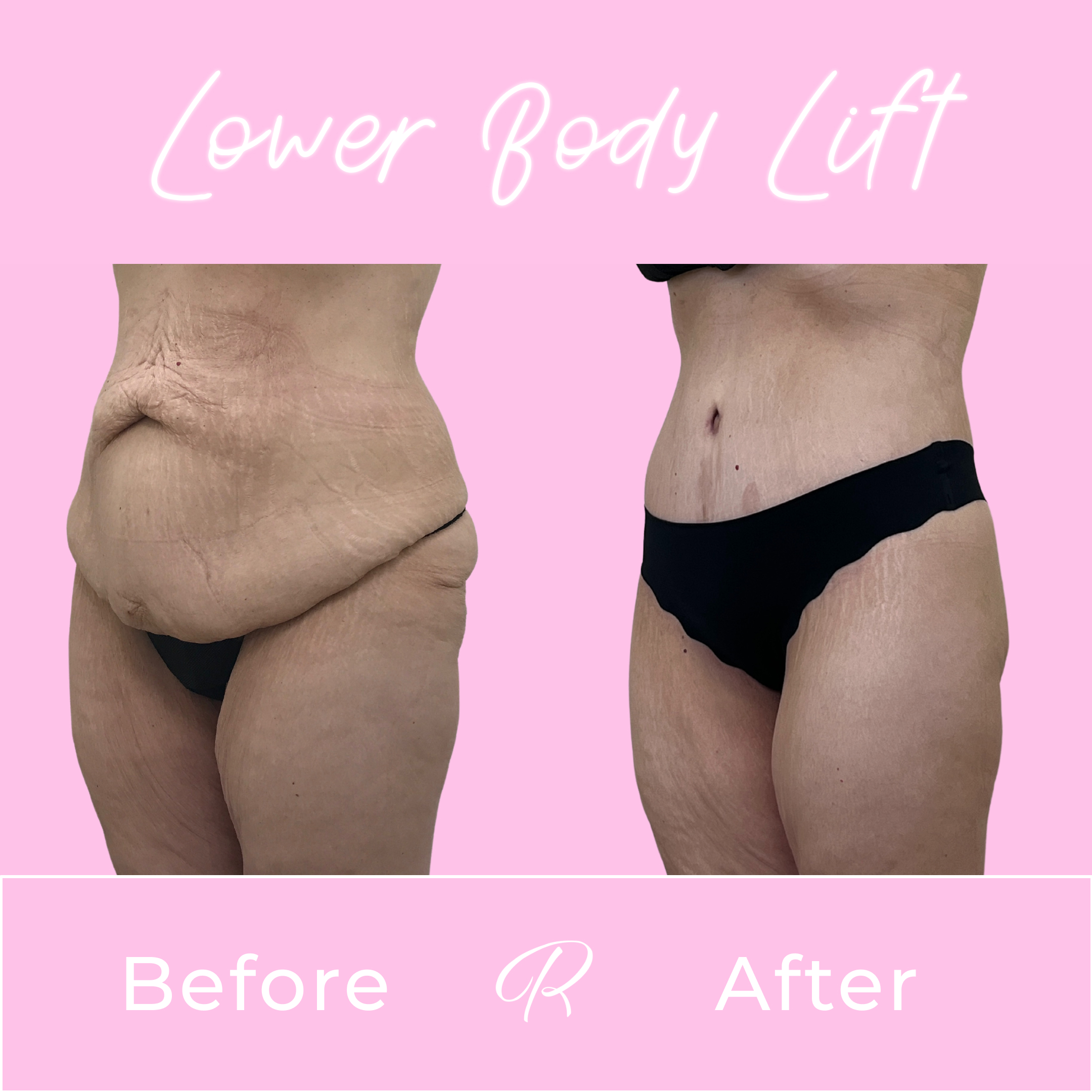 Lower Body Lift Before & After Gallery - Patient 13384 - Image 2