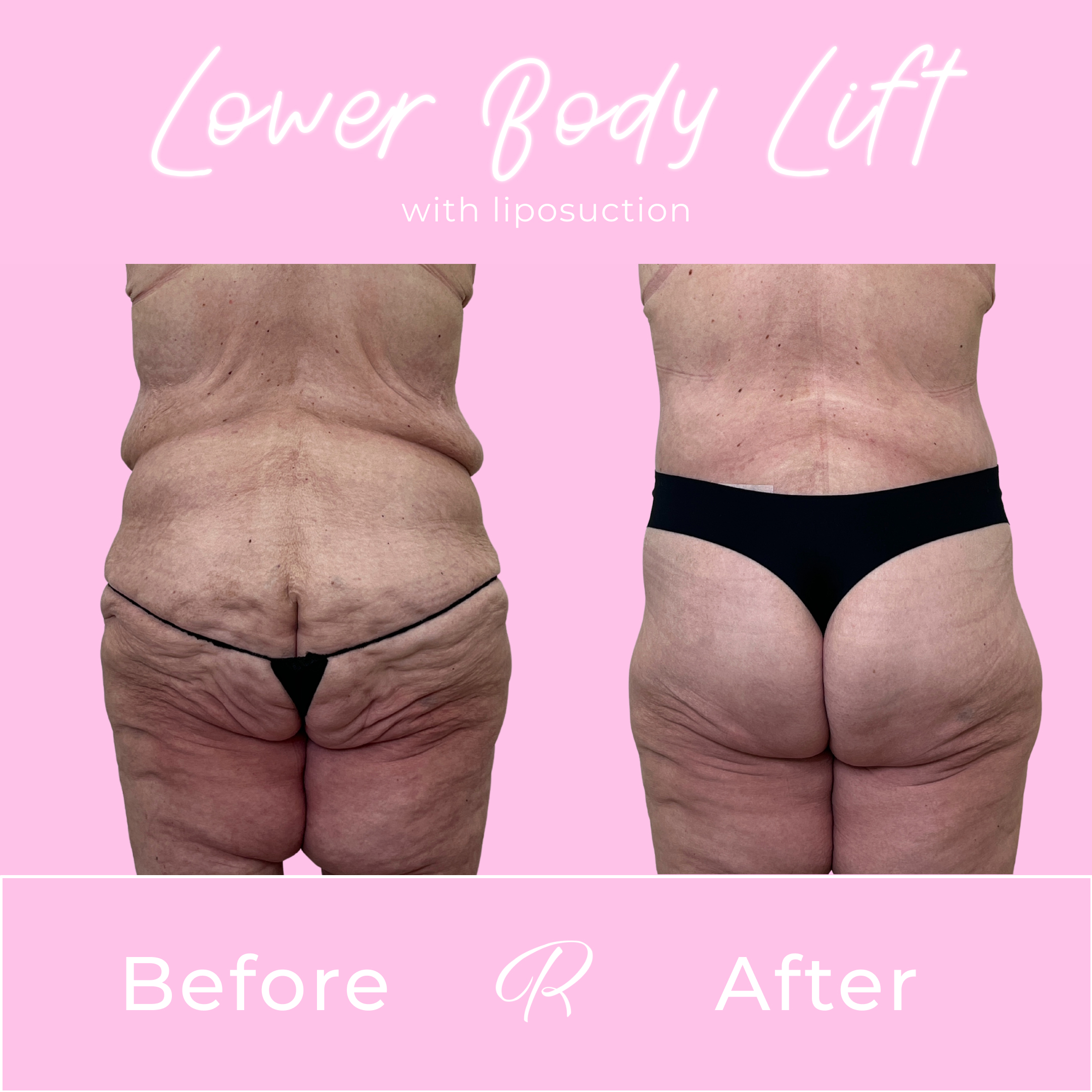 Lower Body Lift Before & After Gallery - Patient 13389 - Image 2