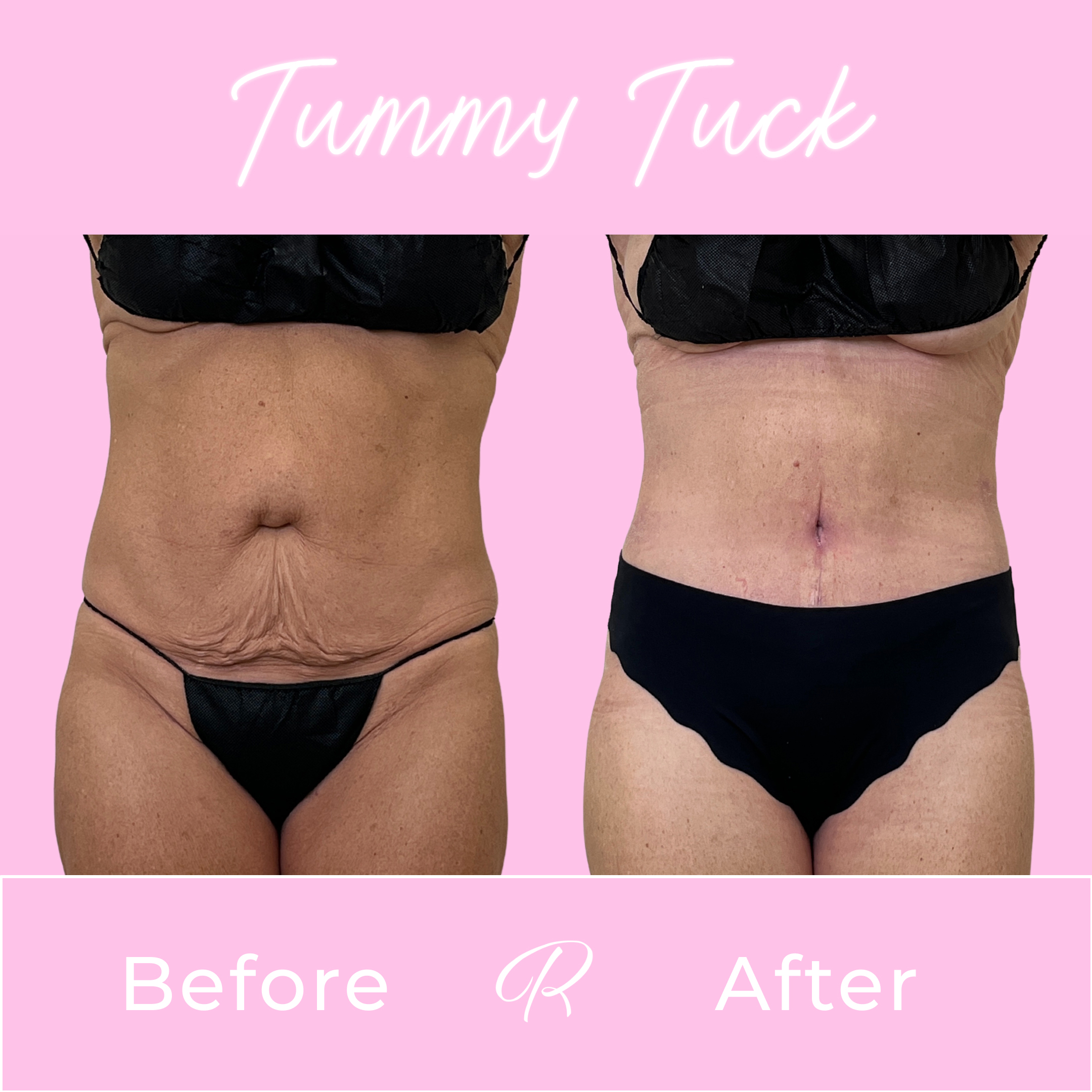 Tummy Tuck Before & After Gallery - Patient 13318 - Image 1