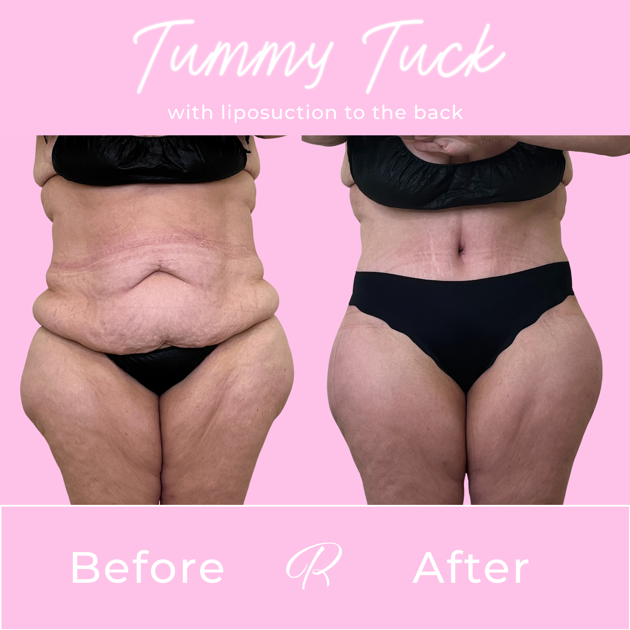 Tummy Tuck Before & After Gallery - Patient 13322 - Image 1