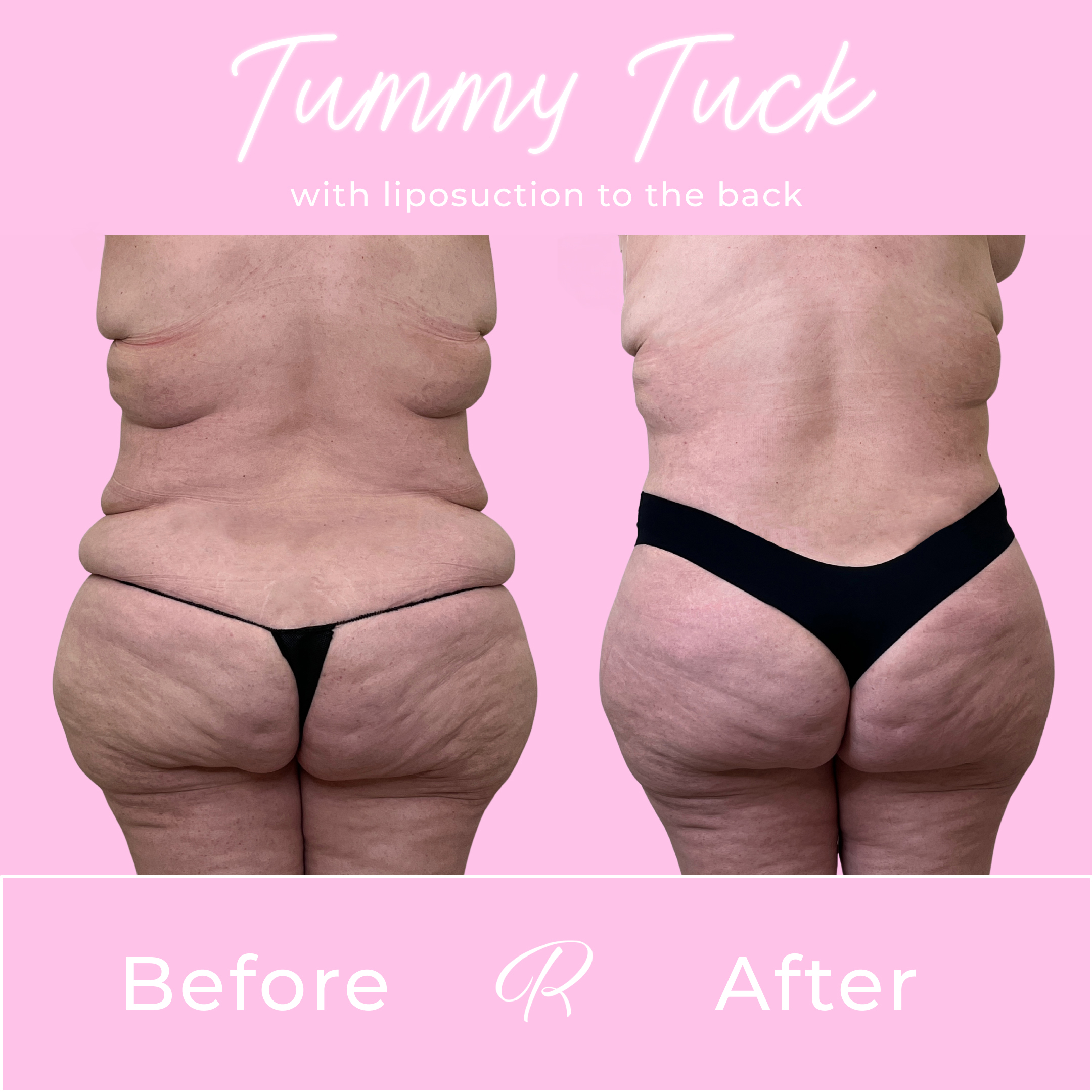 Tummy Tuck Before & After Gallery - Patient 13322 - Image 3