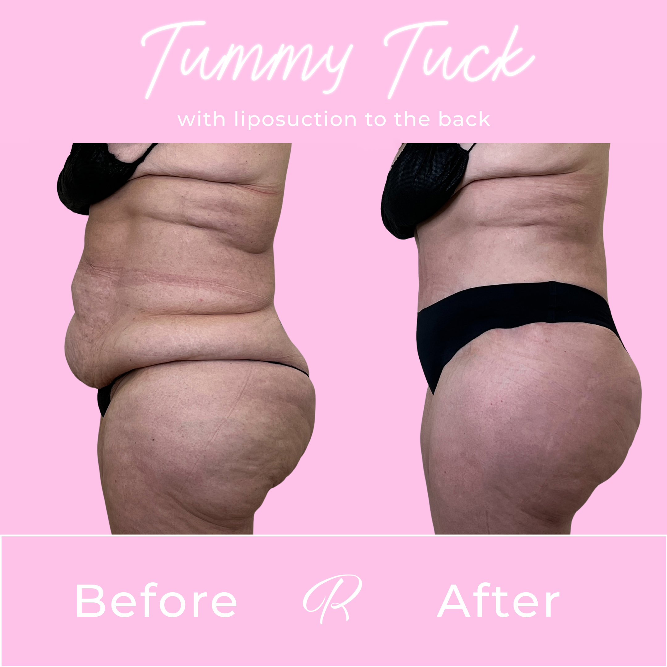 Tummy Tuck Before & After Gallery - Patient 13322 - Image 2