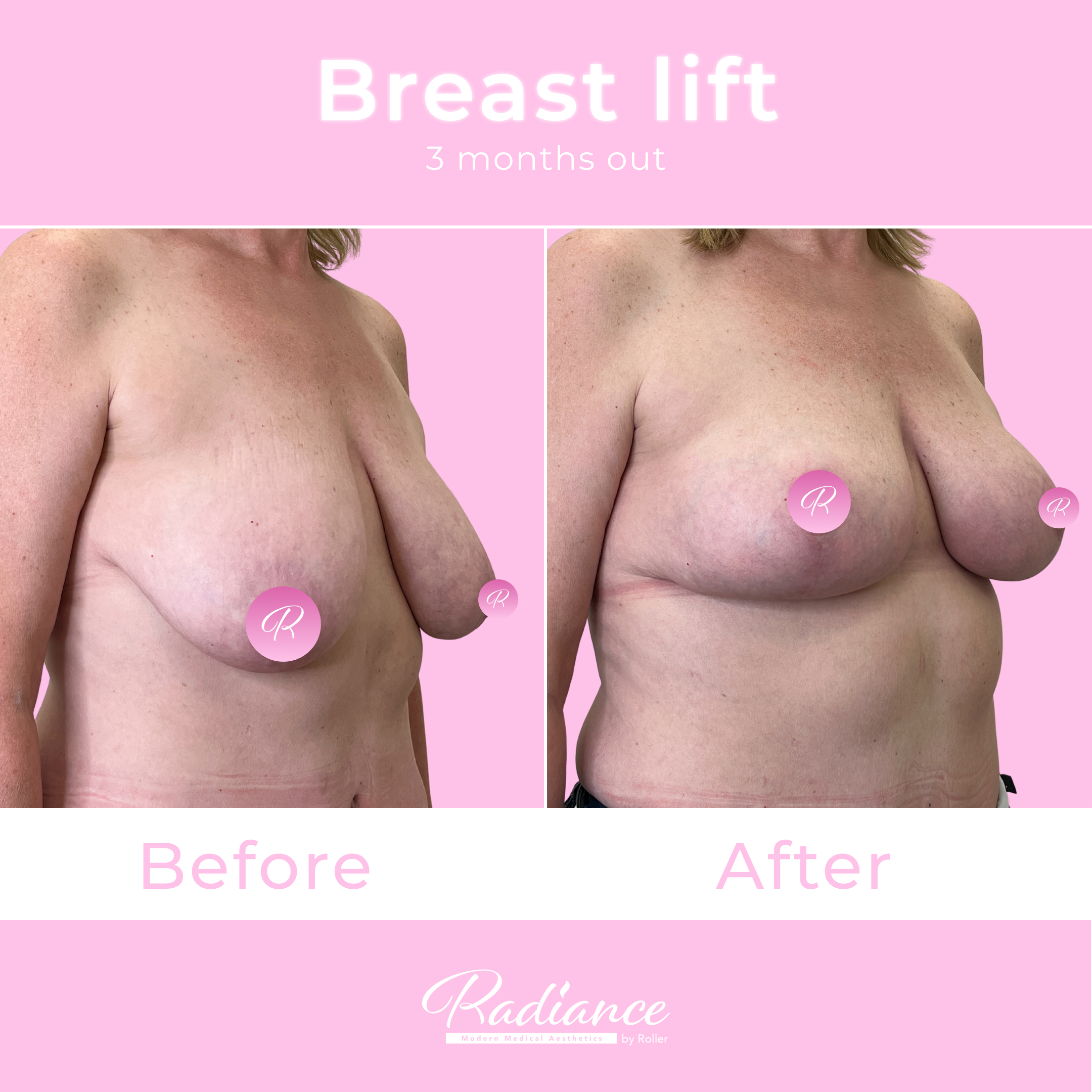 Breast Lift Before & After Gallery - Patient 13410 - Image 4