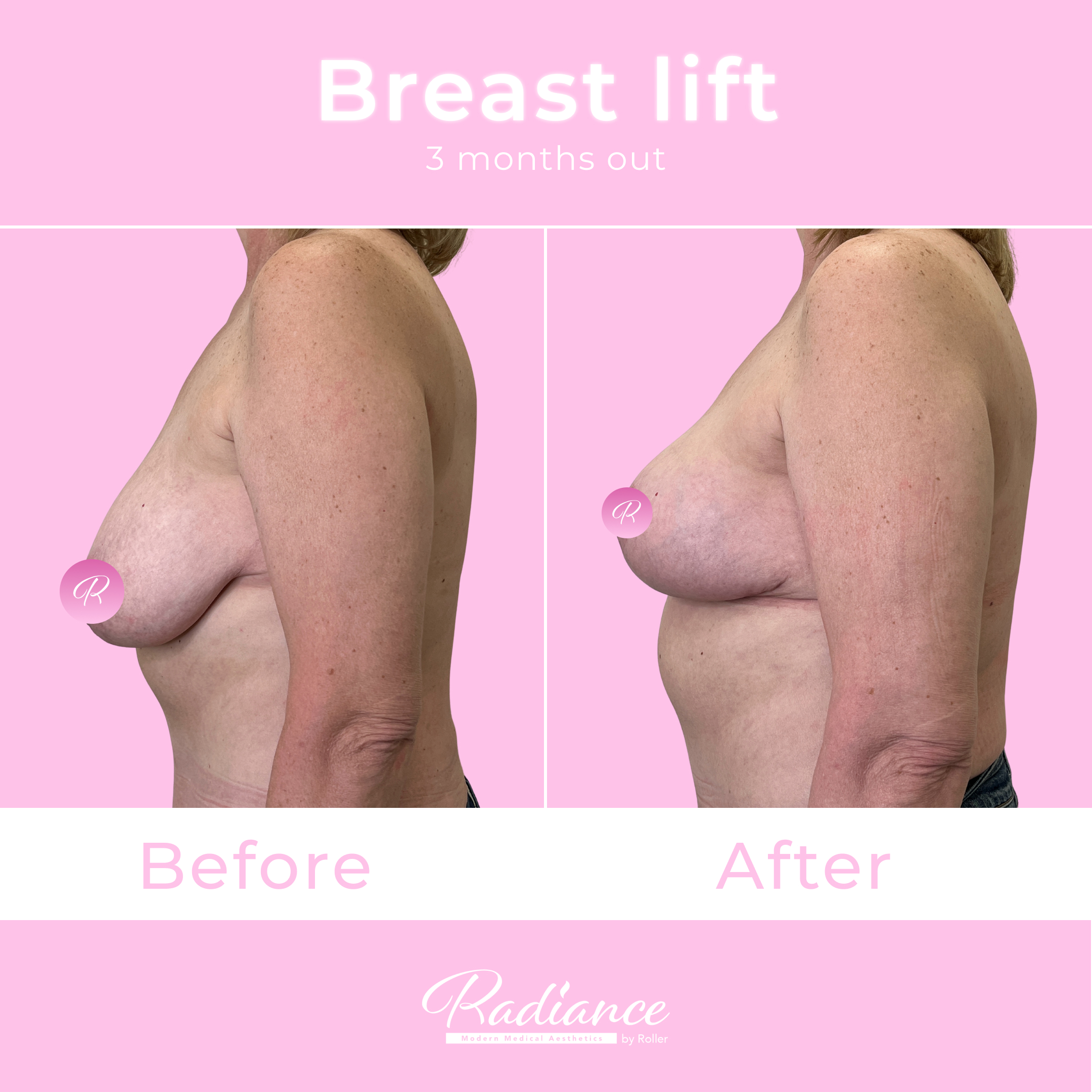 Breast Lift Before & After Gallery - Patient 13410 - Image 1