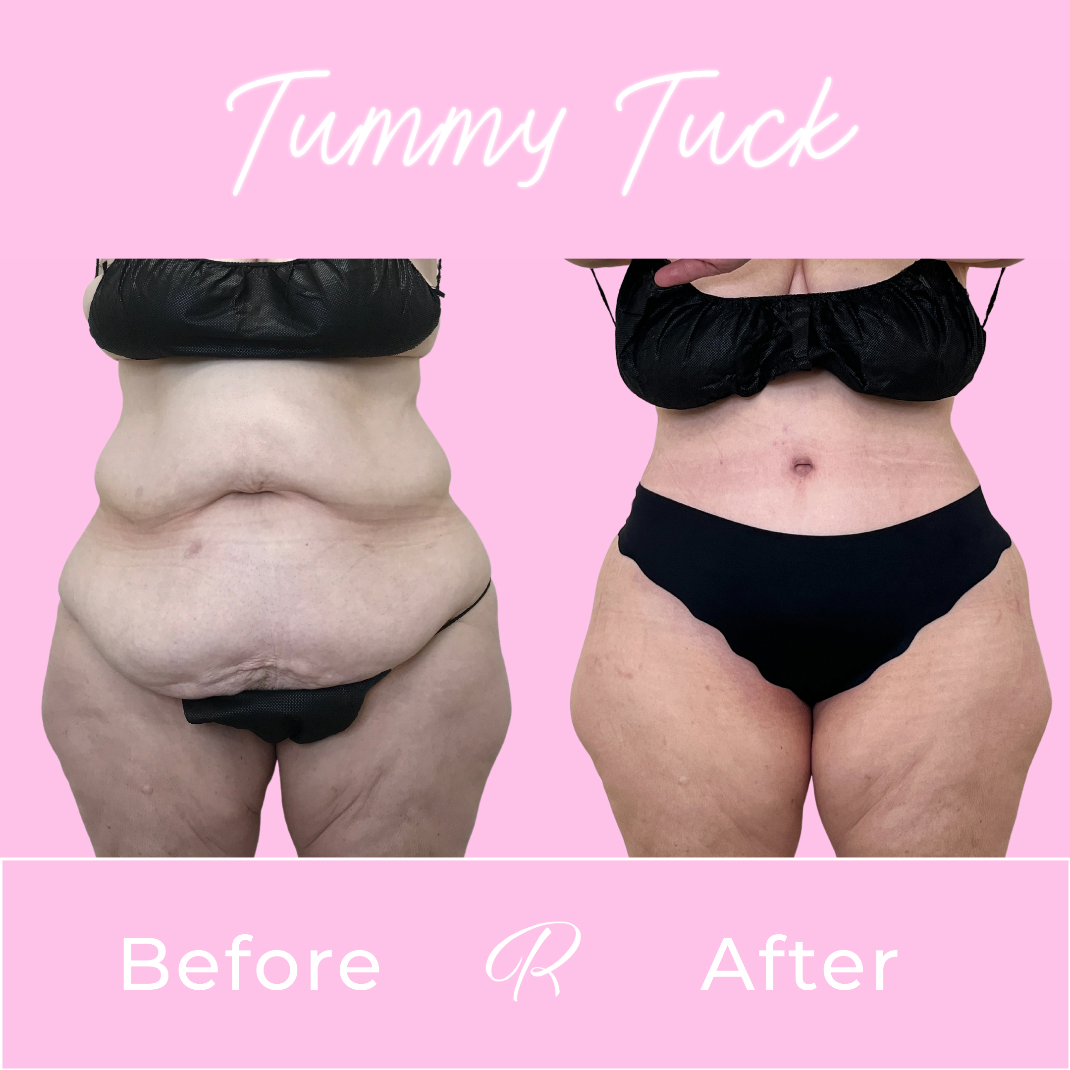 Tummy Tuck Before & After Gallery - Patient 13326 - Image 1