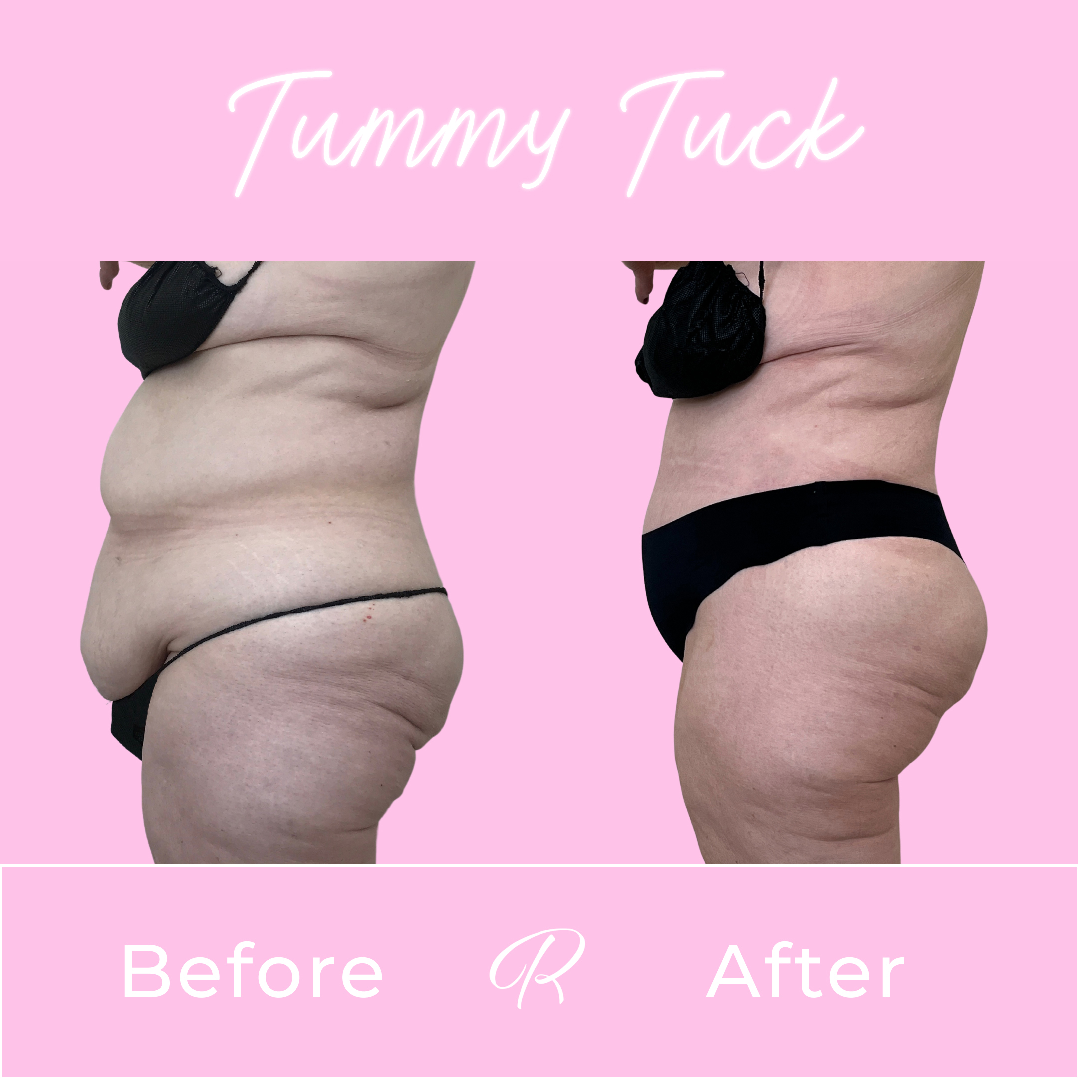 Tummy Tuck Before & After Gallery - Patient 13326 - Image 3