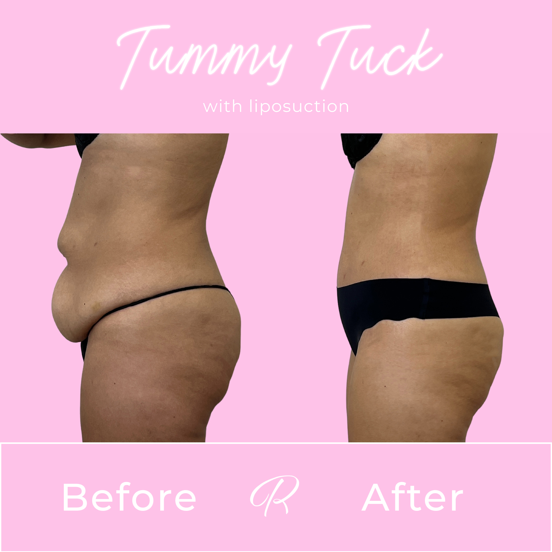 Tummy Tuck Before & After Gallery - Patient 13330 - Image 3