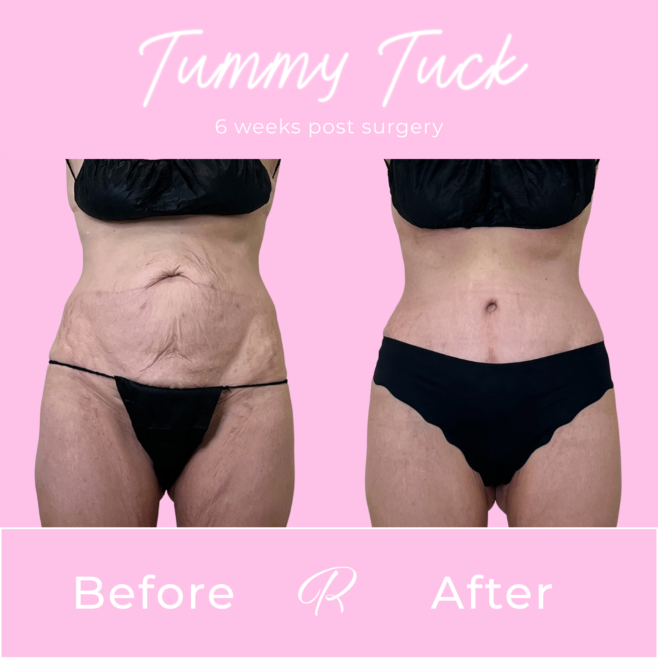 Tummy Tuck Before & After Gallery - Patient 13334 - Image 1
