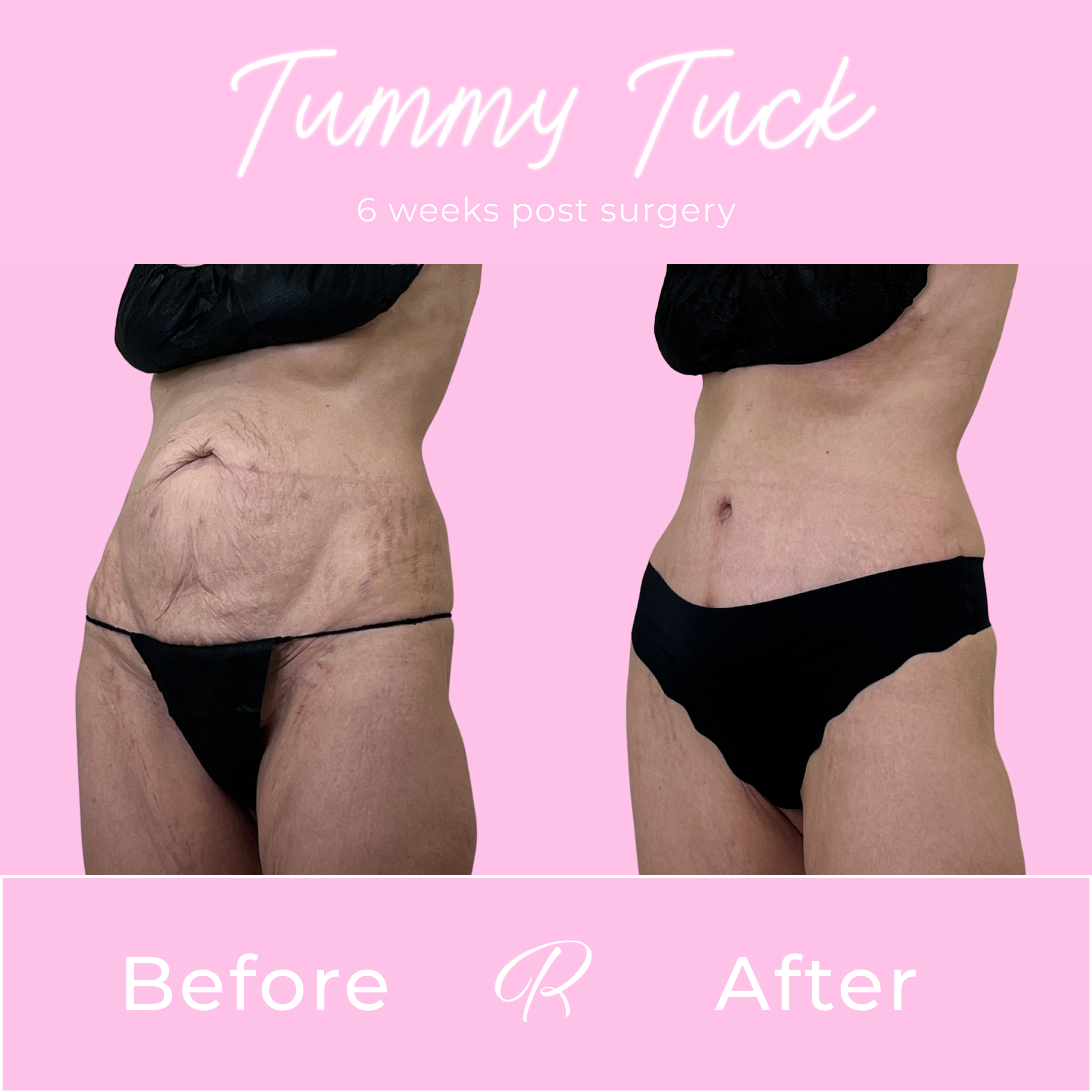 Tummy Tuck Before & After Gallery - Patient 13334 - Image 2