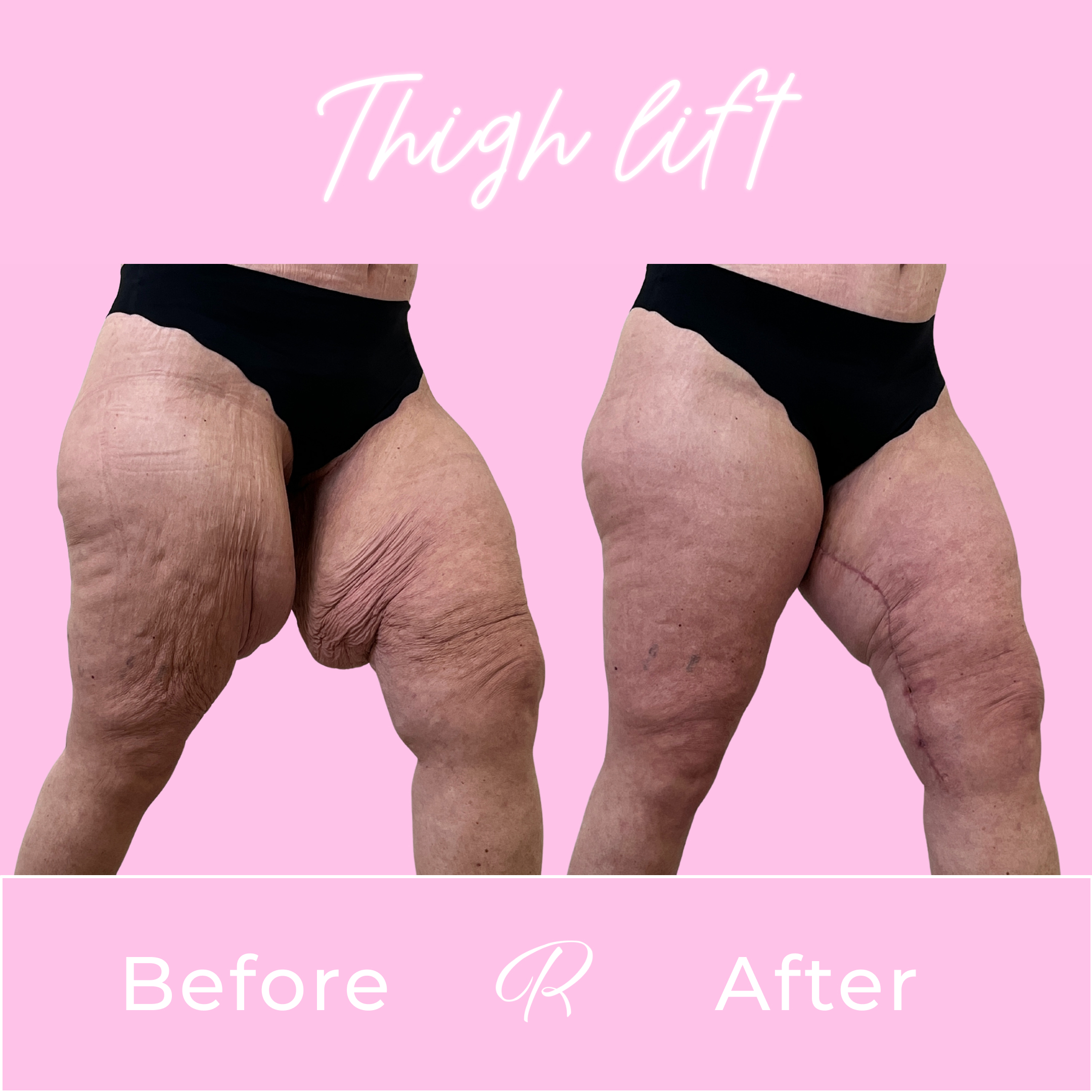 Thigh Lift Before & After Gallery - Patient 13372 - Image 2