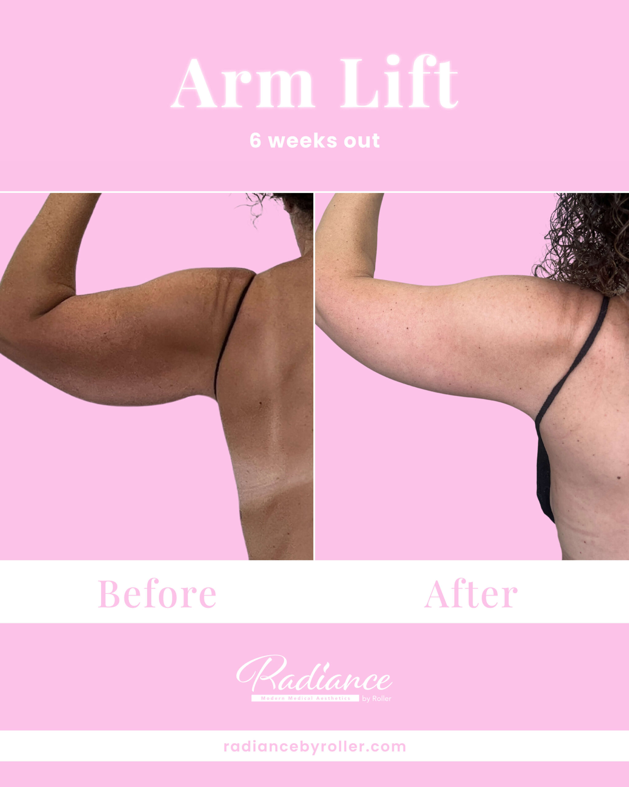 Arm Lift Before & After Gallery - Patient 13445 - Image 1