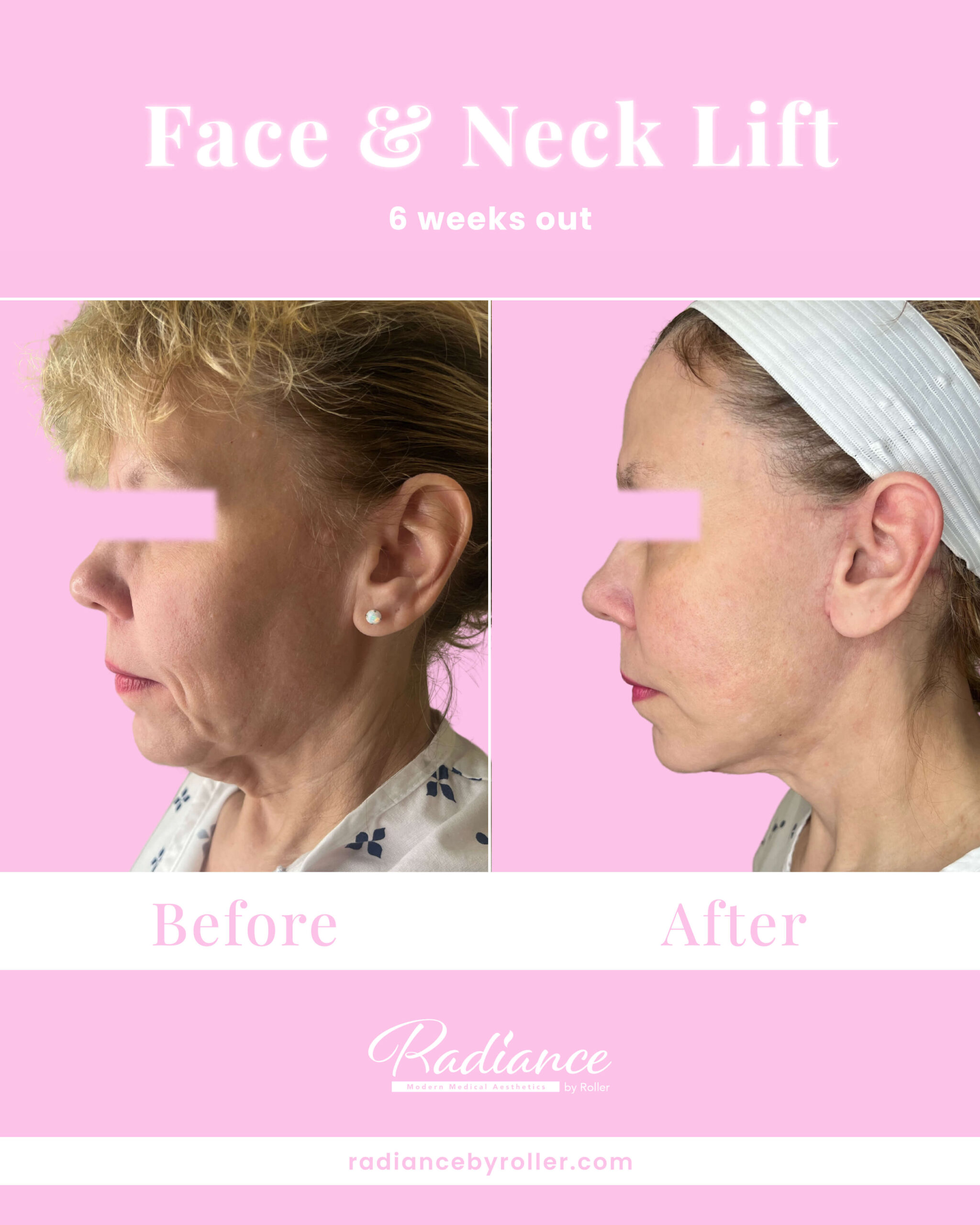 Neck Lift Before & After Gallery - Patient 13376 - Image 2