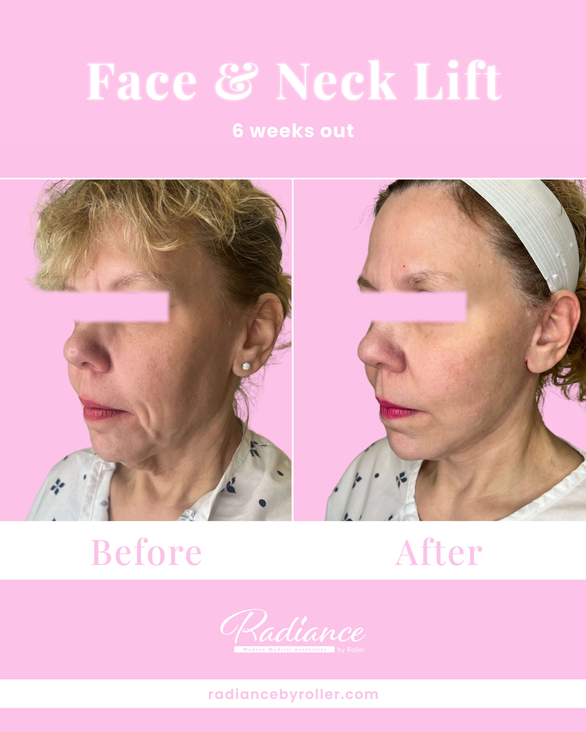 Neck Lift Before & After Gallery - Patient 13376 - Image 1