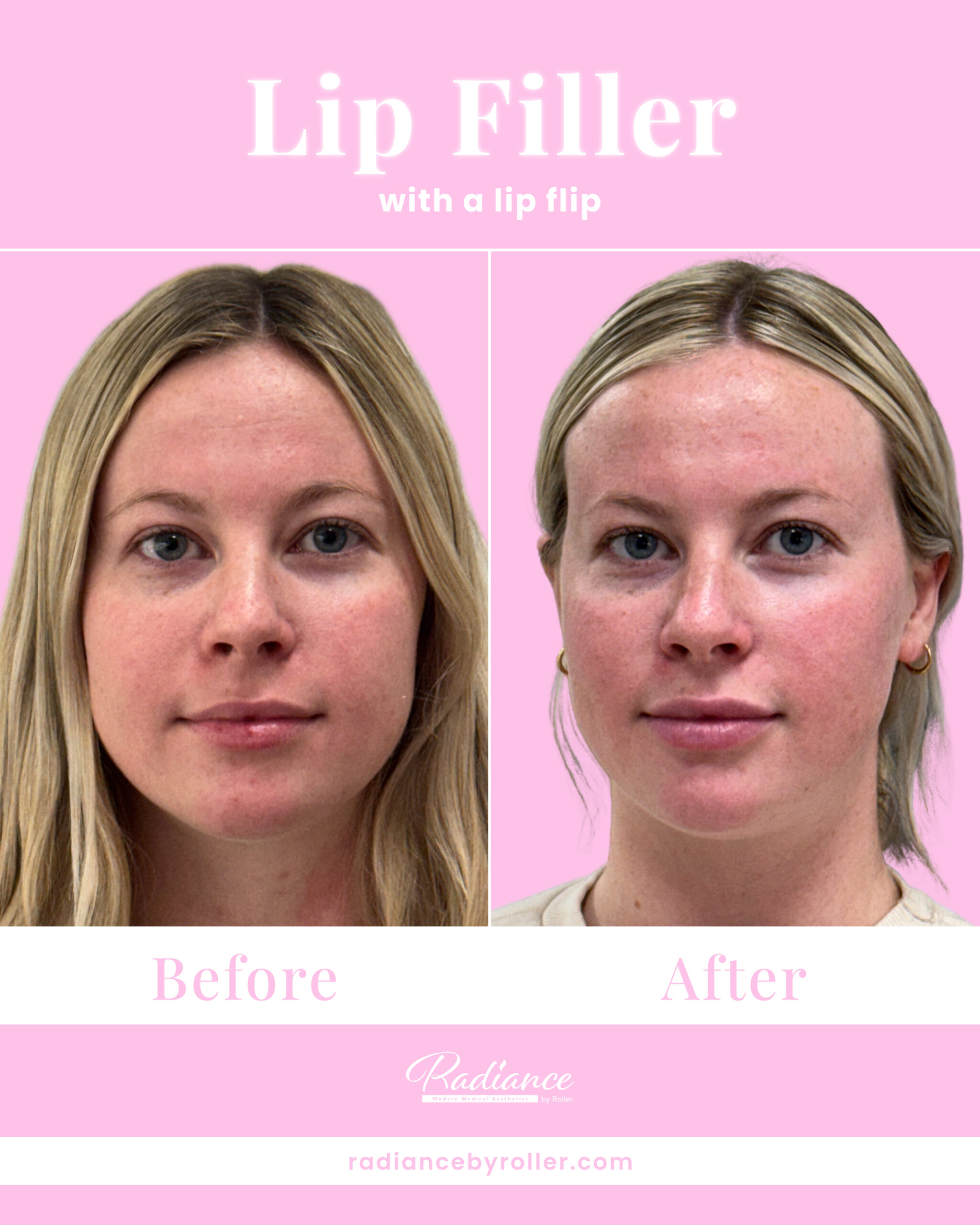 Fillers Before & After Gallery - Patient 12520 - Image 1
