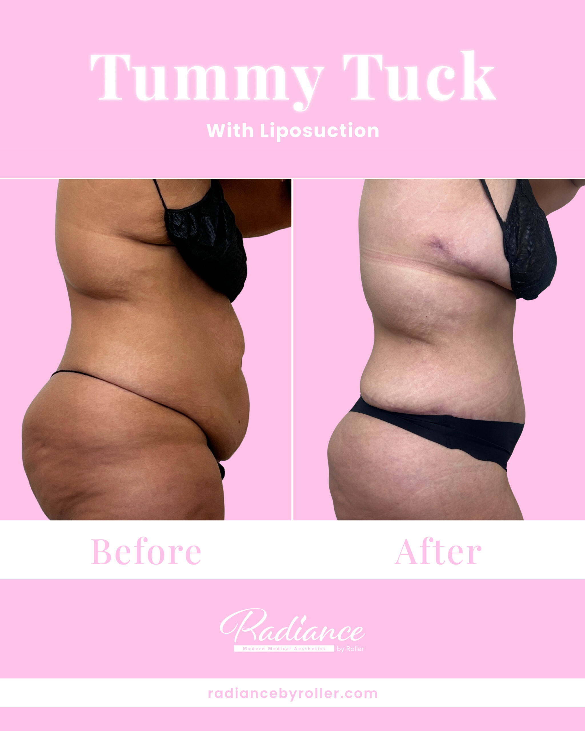 Tummy Tuck Before & After Gallery - Patient 13360 - Image 2
