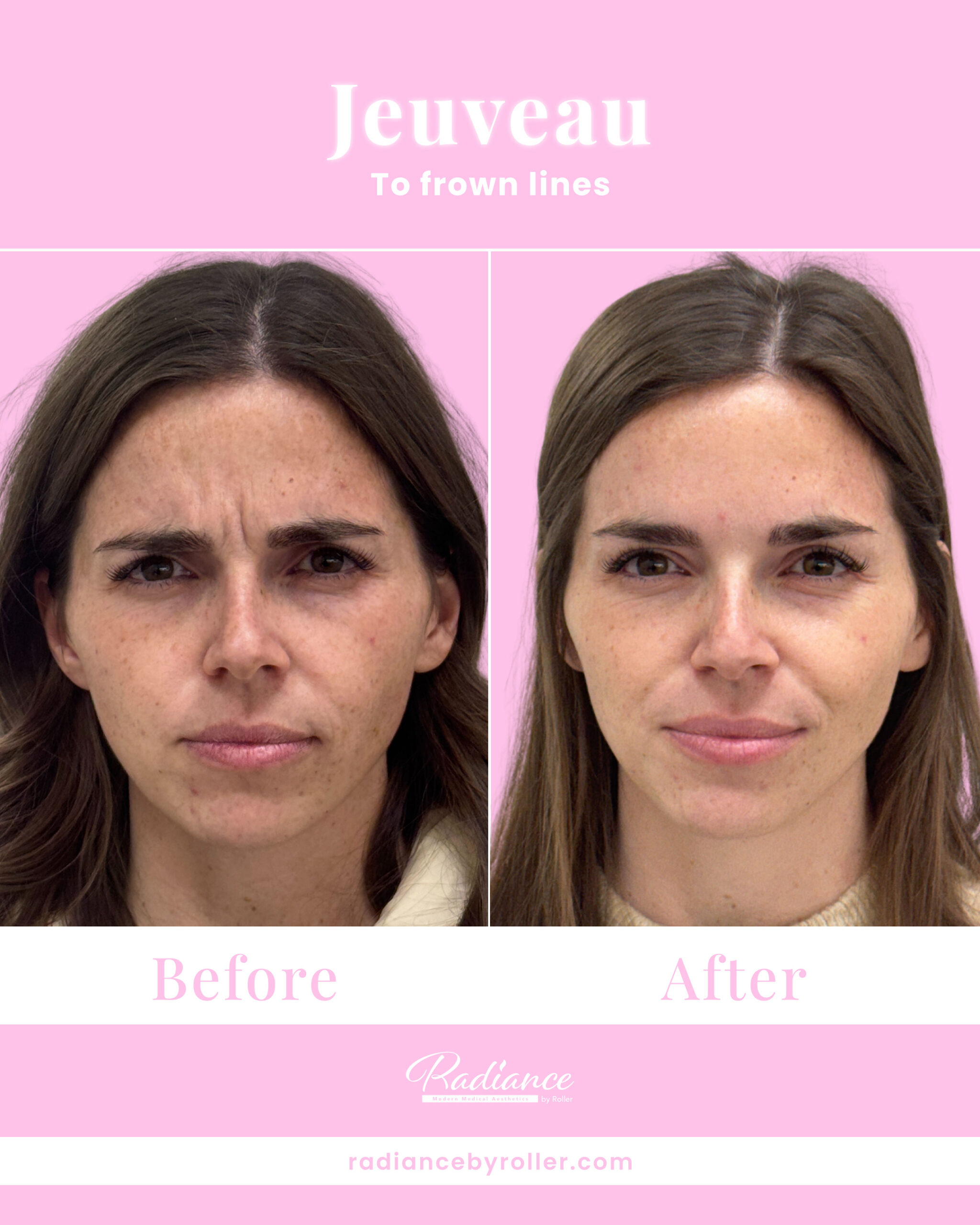 Jeuveau Before & After Gallery - Patient 14719 - Image 1