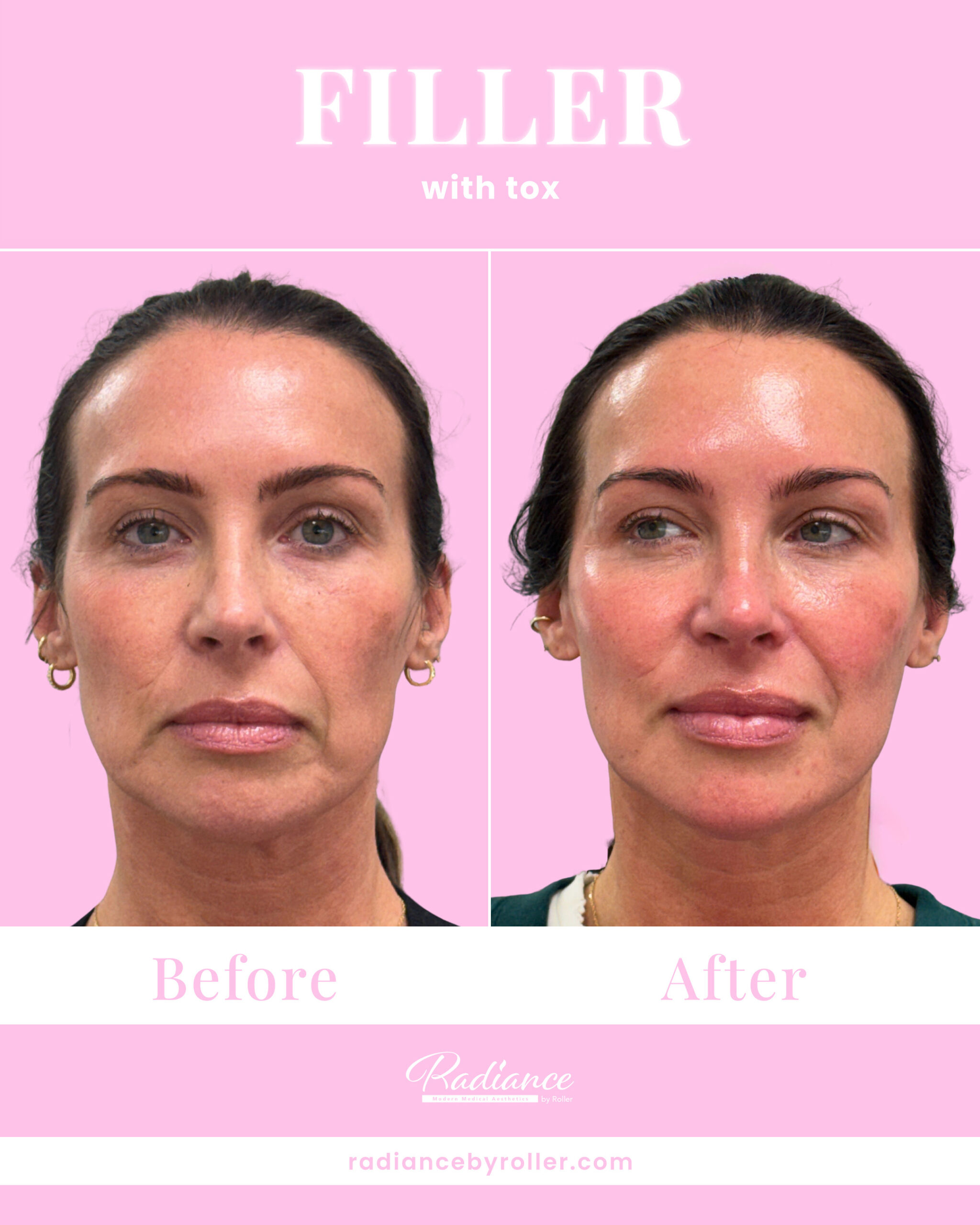 Fillers Before & After Gallery - Patient 14723 - Image 1