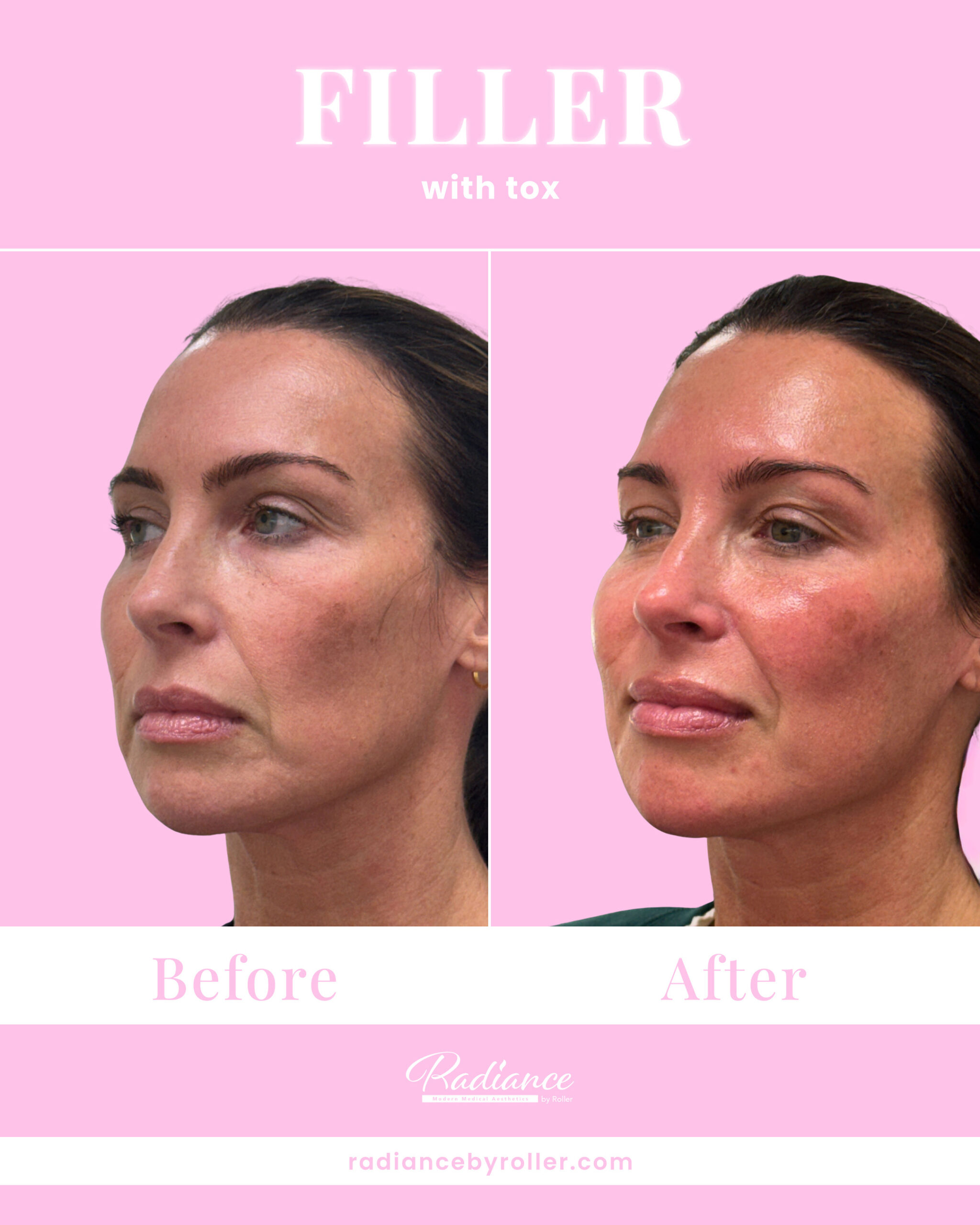 Fillers Before & After Gallery - Patient 14725 - Image 1