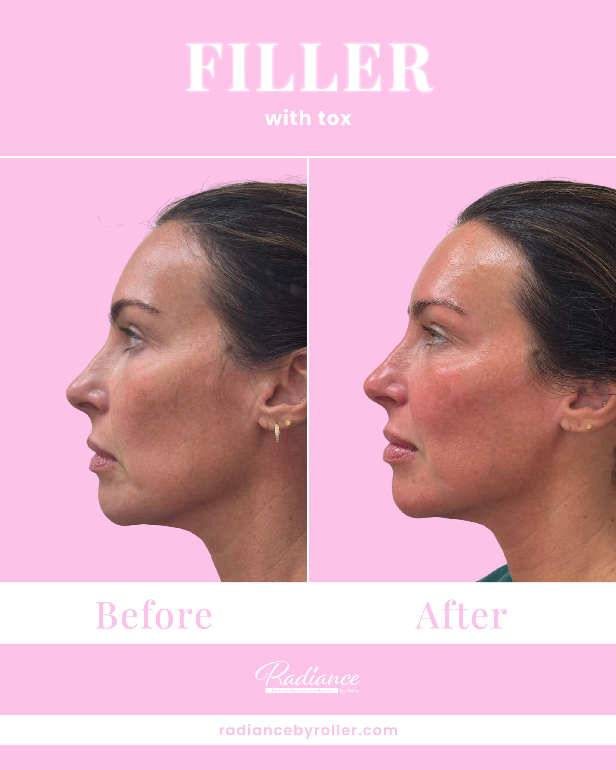 Fillers Before & After Gallery - Patient 14727 - Image 1